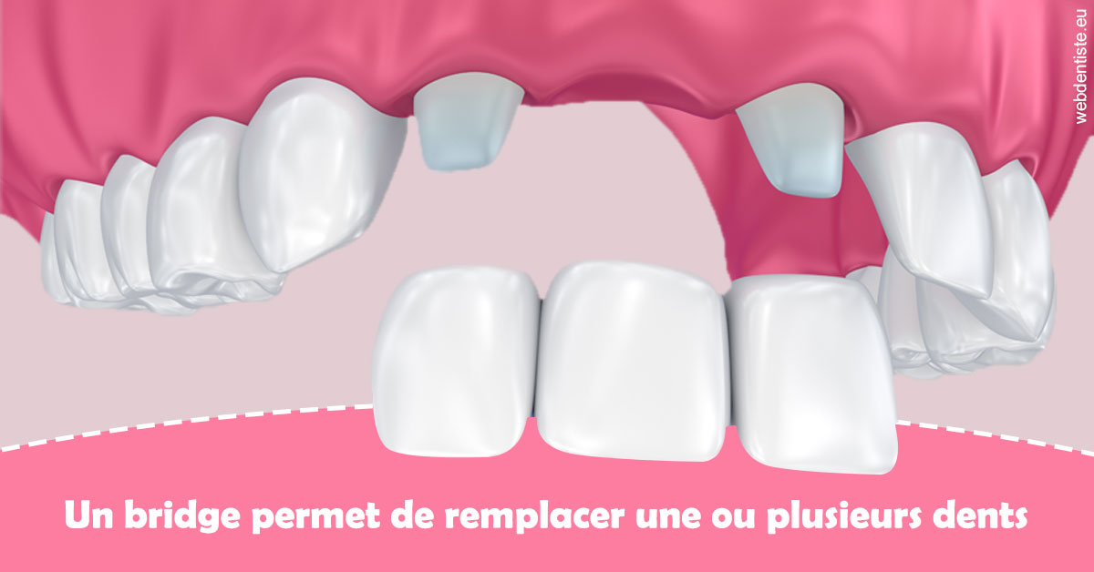 https://selarl-patrick-moheng-et-nicolas-moheng.chirurgiens-dentistes.fr/Bridge remplacer dents 2
