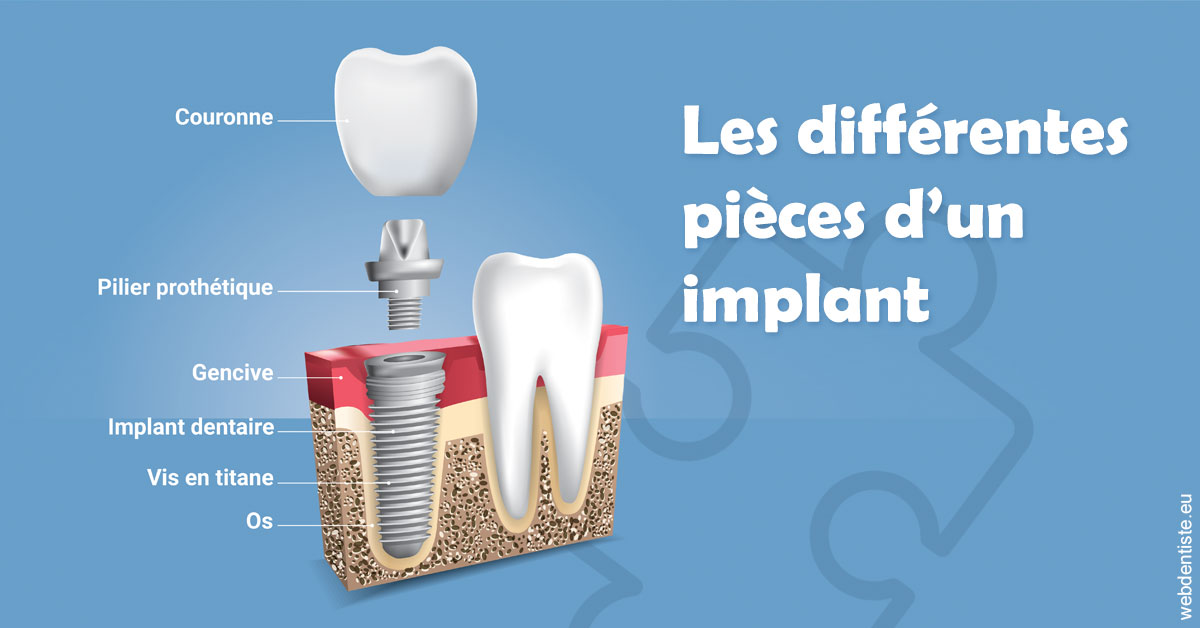 https://selarl-patrick-moheng-et-nicolas-moheng.chirurgiens-dentistes.fr/Les différentes pièces d’un implant 1